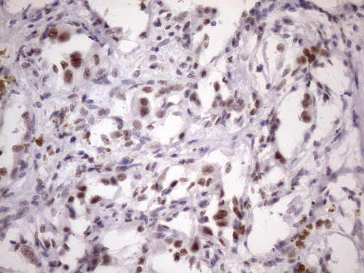 IHC of paraffin-embedded Carcinoma of Human kidney tissue using anti-SRSF9 mouse monoclonal antibody. (Heat-induced epitope retrieval by Tris-EDTA, pH8.0)(1:150).