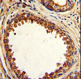 Formalin-fixed and paraffin-embedded human prostate carcinoma with PTP4A2 Antibody , which was peroxidase-conjugated to the secondary antibody, followed by DAB staining. This data demonstrates the use of this antibody for immunohistochemistry; clinical relevance has not been evaluated.