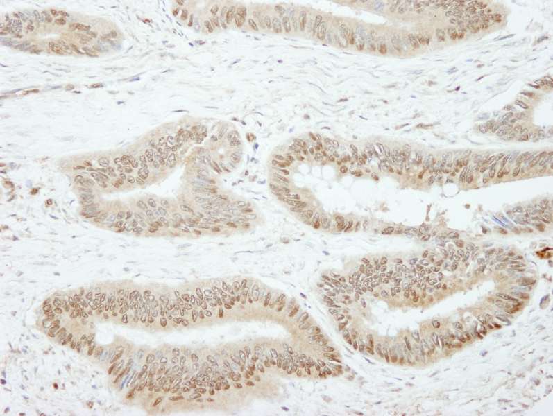 Detection of Human SSH3 by Immunohistochemistry. Sample: FFPE section of human colon carcinoma. Antibody: Affinity purified rabbit anti-SSH3 used at a dilution of 1:250.