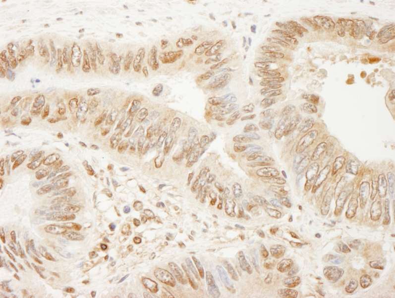 Detection of Human SSH3 by Immunohistochemistry. Sample: FFPE section of human colon carcinoma. Antibody: Affinity purified rabbit anti-SSH3 used at a dilution of 1:200 (1 ug/ml). Detection: DAB.