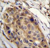 SSH3 Antibody immunohistochemistry of formalin-fixed and paraffin-embedded human breast carcinoma followed by peroxidase-conjugated secondary antibody and DAB staining.