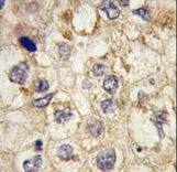Formalin-fixed and paraffin-embedded human hepatocarcinoma tissue reacted with SSR1 antibody , which was peroxidase-conjugated to the secondary antibody, followed by DAB staining. This data demonstrates the use of this antibody for immunohistochemistry; clinical relevance has not been evaluated.
