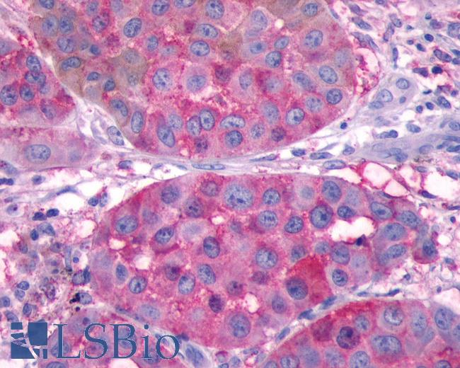 Anti-SSTR2 antibody IHC of human Skin, Melanoma. Immunohistochemistry of formalin-fixed, paraffin-embedded tissue after heat-induced antigen retrieval.