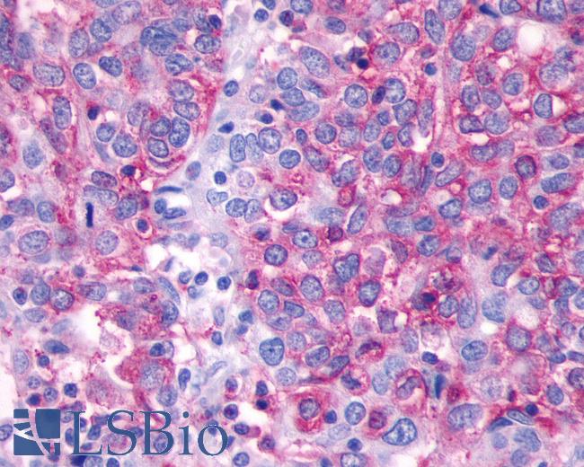 Anti-SSTR2 antibody IHC of human Ovary, Carcinoma. Immunohistochemistry of formalin-fixed, paraffin-embedded tissue after heat-induced antigen retrieval.