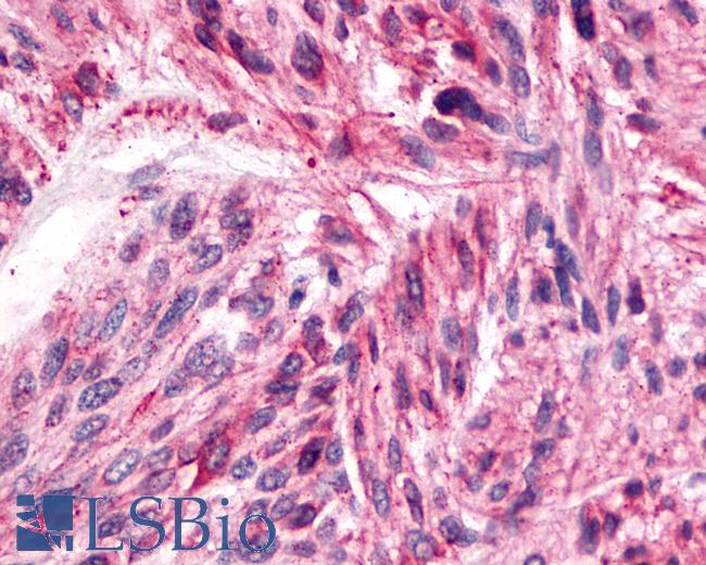 Anti-SSTR4 antibody IHC of human Brain, Glioblastoma. Immunohistochemistry of formalin-fixed, paraffin-embedded tissue after heat-induced antigen retrieval.
