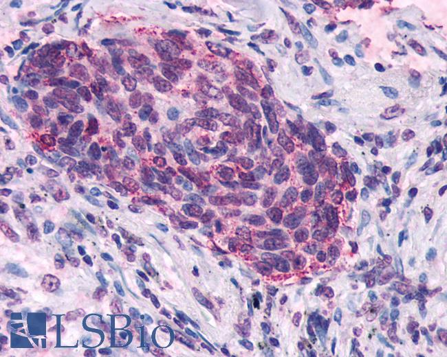 Anti-SSTR5 antibody IHC of human Lung, Small Cell Carcinoma. Immunohistochemistry of formalin-fixed, paraffin-embedded tissue after heat-induced antigen retrieval.