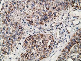 IHC of paraffin-embedded Carcinoma of Human bladder tissue using anti-SSX1 mouse monoclonal antibody.