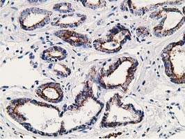 IHC of paraffin-embedded Carcinoma of Human prostate tissue using anti-SSX1 mouse monoclonal antibody. (Heat-induced epitope retrieval by 10mM citric buffer, pH6.0, 100C for 10min).