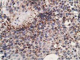 IHC of paraffin-embedded Carcinoma of Human bladder tissue using anti-SSX1 mouse monoclonal antibody. (Heat-induced epitope retrieval by 10mM citric buffer, pH6.0, 100C for 10min).