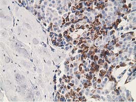 IHC of paraffin-embedded Adenocarcinoma of Human breast tissue using anti-SSX1 mouse monoclonal antibody. (Heat-induced epitope retrieval by 10mM citric buffer, pH6.0, 100C for 10min).