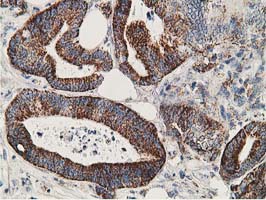 IHC of paraffin-embedded Adenocarcinoma of Human colon tissue using anti-SSX1 mouse monoclonal antibody. (Heat-induced epitope retrieval by 10mM citric buffer, pH6.0, 100C for 10min).