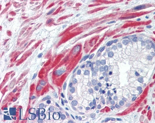 Anti-SSX4 antibody IHC of human prostate. Immunohistochemistry of formalin-fixed, paraffin-embedded tissue after heat-induced antigen retrieval. Antibody LS-B3514 concentration 5 ug/ml.