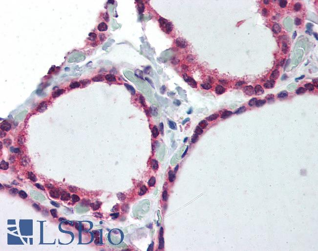 Anti-ST13 / HIP antibody IHC of human thyroid. Immunohistochemistry of formalin-fixed, paraffin-embedded tissue after heat-induced antigen retrieval. Antibody LS-B3054 concentration 10 ug/ml.