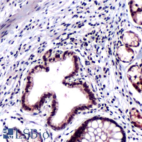Immunohistochemistry of Human Colon Carcinoma stained with anti-ST13 antibody