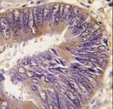 Formalin-fixed and paraffin-embedded human colon carcinoma tissue reacted with ST13 antibody , which was peroxidase-conjugated to the secondary antibody, followed by DAB staining. This data demonstrates the use of this antibody for immunohistochemistry; clinical relevance has not been evaluated.