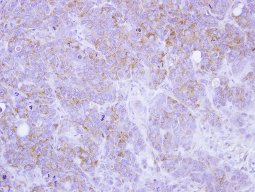 IHC of paraffin-embedded SW480 xenograft using ST3GAL2 antibody at 1:100 dilution.