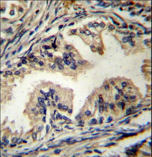 STAMBP Antibody immunohistochemistry of formalin-fixed and paraffin-embedded human prostate carcinoma followed by peroxidase-conjugated secondary antibody and DAB staining.