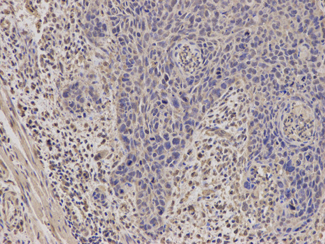 Immunohistochemistry of paraffin-embedded human esophageal cancer using STAR antibody at dilution of 1:100 (200x lens).