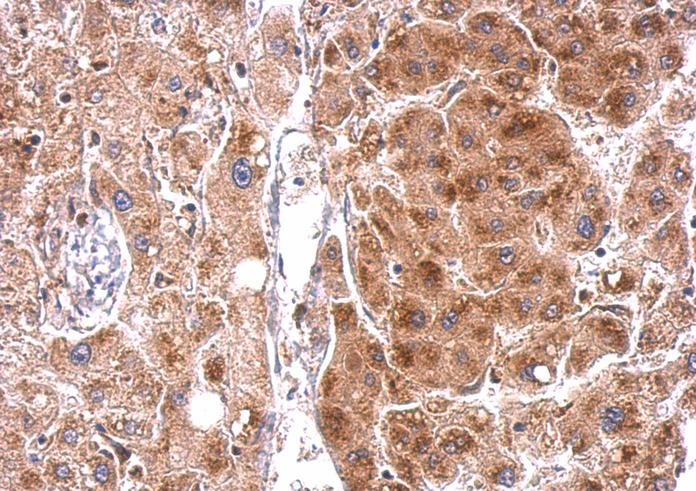 STAR antibody detects STAR protein at cytosol on hepatoma by immunohistochemical analysis. Sample: Paraffin-embedded hepatoma. STAR antibody dilution:1:500.