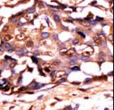 Formalin-fixed and paraffin-embedded human cancer tissue reacted with the primary antibody, which was peroxidase-conjugated to the secondary antibody, followed by DAB staining. This data demonstrates the use of this antibody for immunohistochemistry; clinical relevance has not been evaluated. BC = breast carcinoma; HC = hepatocarcinoma.