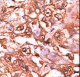 Formalin-fixed and paraffin-embedded human cancer tissue reacted with the primary antibody, which was peroxidase-conjugated to the secondary antibody, followed by AEC staining. This data demonstrates the use of this antibody for immunohistochemistry; clinical relevance has not been evaluated. BC = breast carcinoma; HC = hepatocarcinoma.