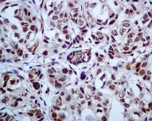 IHC of paraffin-embedded human breast carcinoma tissue using anti-PRP19 antibody.