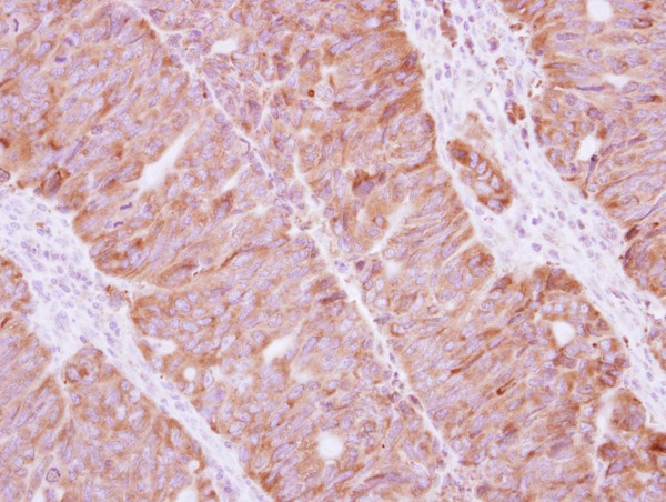 IHC of paraffin-embedded Colon ca, using Staufen antibody at 1:500 dilution.