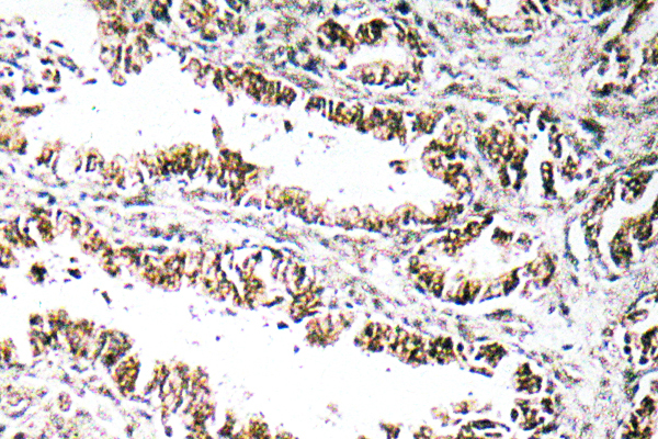 IHC of STEAP1 (D31) pAb in paraffin-embedded human prostate carcinoma tissue.