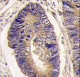 Formalin-fixed and paraffin-embedded human colon carcinoma tissue reacted with PTPH1 antibody , which was peroxidase-conjugated to the secondary antibody, followed by DAB staining. This data demonstrates the use of this antibody for immunohistochemistry; clinical relevance has not been evaluated.