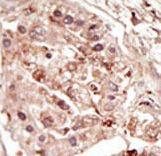 Formalin-fixed and paraffin-embedded human cancer tissue reacted with the primary antibody, which was peroxidase-conjugated to the secondary antibody, followed by DAB staining. This data demonstrates the use of this antibody for immunohistochemistry; clinical relevance has not been evaluated. BC = breast carcinoma; HC = hepatocarcinoma.
