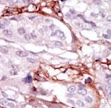 Formalin-fixed and paraffin-embedded human cancer tissue reacted with the primary antibody, which was peroxidase-conjugated to the secondary antibody, followed by DAB staining. This data demonstrates the use of this antibody for immunohistochemistry; clinical relevance has not been evaluated. BC = breast carcinoma; HC = hepatocarcinoma.