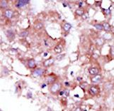 Formalin-fixed and paraffin-embedded human cancer tissue reacted with the primary antibody, which was peroxidase-conjugated to the secondary antibody, followed by DAB staining. This data demonstrates the use of this antibody for immunohistochemistry; clinical relevance has not been evaluated. BC = breast carcinoma; HC = hepatocarcinoma.