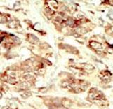 Formalin-fixed and paraffin-embedded human cancer tissue reacted with the primary antibody, which was peroxidase-conjugated to the secondary antibody, followed by DAB staining. This data demonstrates the use of this antibody for immunohistochemistry; clinical relevance has not been evaluated. BC = breast carcinoma; HC = hepatocarcinoma.