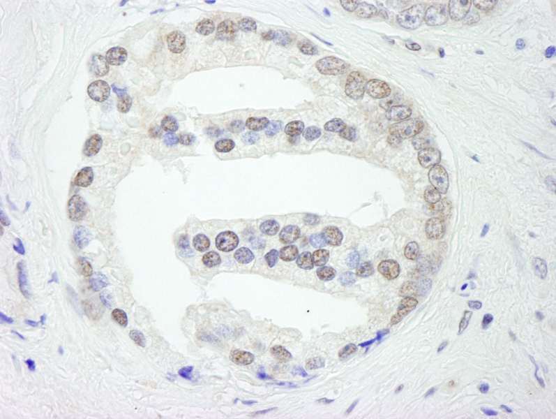 Detection of Human PRP19/PSO4 by Immunohistochemistry. Sample: FFPE section of human prostate adenocarcinoma. Antibody: Affinity purified rabbit anti-PRP19/PSO4 used at a dilution of 1:250.