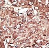 Formalin-fixed and paraffin-embedded human cancer tissue reacted with the primary antibody, which was peroxidase-conjugated to the secondary antibody, followed by AEC staining. This data demonstrates the use of this antibody for immunohistochemistry; clinical relevance has not been evaluated. BC = breast carcinoma; HC = hepatocarcinoma.