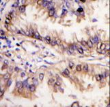 Formalin-fixed and paraffin-embedded human lung carcinoma tissue reacted with STK39 antibody , which was peroxidase-conjugated to the secondary antibody, followed by DAB staining. This data demonstrates the use of this antibody for immunohistochemistry; clinical relevance has not been evaluated.