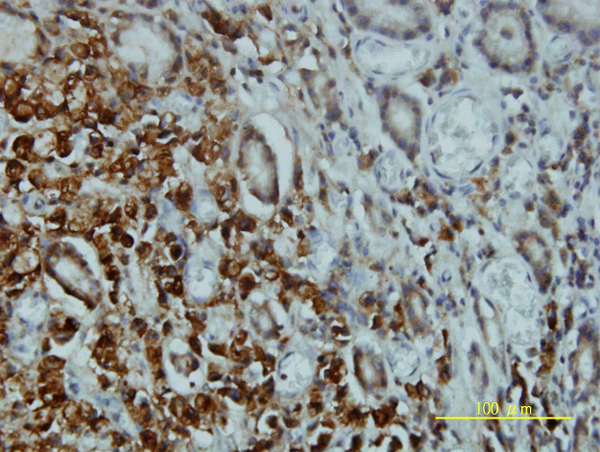 Immunoperoxidase of monoclonal antibody to STK4 on formalin-fixed paraffin-embedded human stomach carcinoma tissue. [antibody concentration 5 ug/ml].