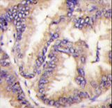 Formalin-fixed and paraffin-embedded human lung carcinoma tissue reacted with STK9 Antibody , which was peroxidase-conjugated to the secondary antibody, followed by DAB staining. This data demonstrates the use of this antibody for immunohistochemistry; clinical relevance has not been evaluated.