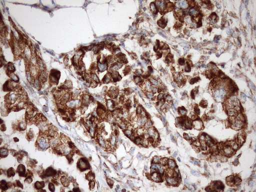 IHC of paraffin-embedded Adenocarcinoma of Human endometrium tissue using anti-STOML2 mouse monoclonal antibody. (Heat-induced epitope retrieval by Tris-EDTA, pH8.0)(1:150).