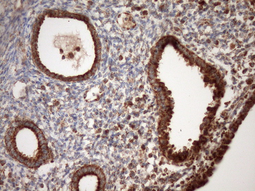 IHC of paraffin-embedded Carcinoma of Human pancreas tissue using anti-STOML2 mouse monoclonal antibody. (Heat-induced epitope retrieval by Tris-EDTA, pH8.0)(1:150).