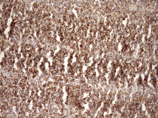 IHC of paraffin-embedded Human lymphoma tissue using anti-STOML2 mouse monoclonal antibody. (Heat-induced epitope retrieval by Tris-EDTA, pH8.0)(1:150).