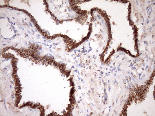 IHC of paraffin-embedded Carcinoma of Human prostate tissue using anti-STOML2 mouse monoclonal antibody. (Heat-induced epitope retrieval by Tris-EDTA, pH8.0)(1:150).