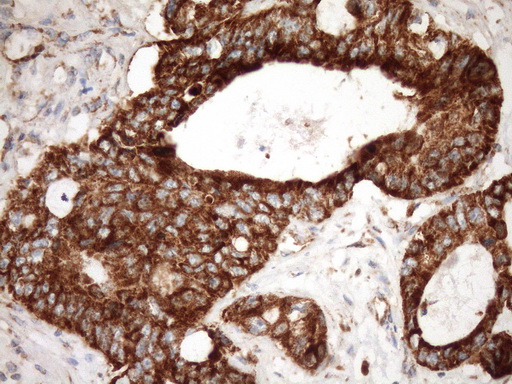 IHC of paraffin-embedded Adenocarcinoma of Human colon tissue using anti-STOML2 mouse monoclonal antibody. (Heat-induced epitope retrieval by Tris-EDTA, pH8.0)(1:150).