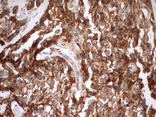 IHC of paraffin-embedded Adenocarcinoma of Human breast tissue using anti-STOML2 mouse monoclonal antibody. (Heat-induced epitope retrieval by Tris-EDTA, pH8.0)(1:150).
