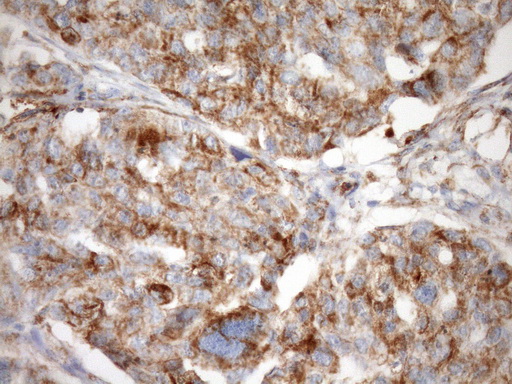 IHC of paraffin-embedded Adenocarcinoma of Human ovary tissue using anti-STOML2 mouse monoclonal antibody. (Heat-induced epitope retrieval by Tris-EDTA, pH8.0)(1:150).