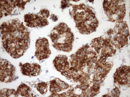 IHC of paraffin-embedded Carcinoma of Human liver tissue using anti-STOML2 mouse monoclonal antibody. (Heat-induced epitope retrieval by Tris-EDTA, pH8.0)(1:150).
