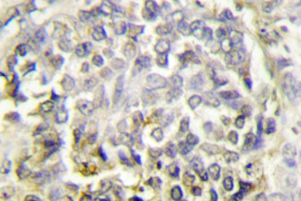 IHC of ASC (E13) pAb in paraffin-embedded human lung carcinoma tissue.
