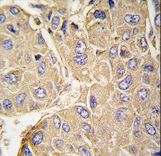 Formalin-fixed and paraffin-embedded human hepatocarcinoma tissue reacted with PTPN7 Antibody (S44) , which was peroxidase-conjugated to the secondary antibody, followed by DAB staining. This data demonstrates the use of this antibody for immunohistochemistry; clinical relevance has not been evaluated.