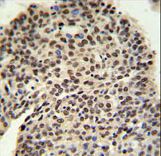PRPF19 Antibody IHC of formalin-fixed and paraffin-embedded lung carcinoma followed by peroxidase-conjugated secondary antibody and DAB staining.
