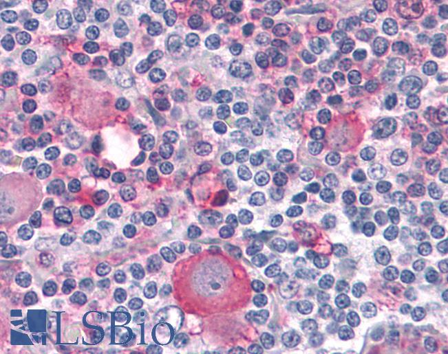 Anti-PTPRA / RPTP-Alpha antibody IHC of human Skin, Melanoma. Immunohistochemistry of formalin-fixed, paraffin-embedded tissue after heat-induced antigen retrieval.
